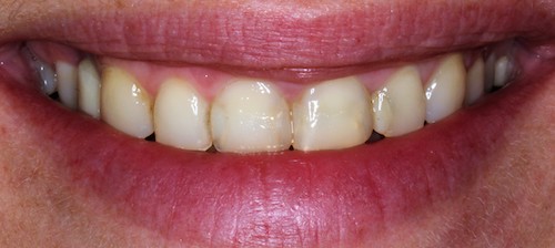 Dentell