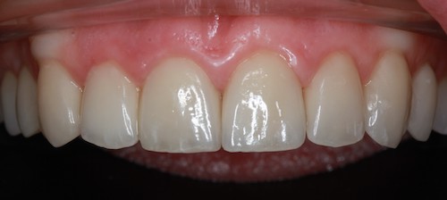 Dentell