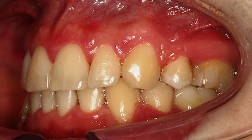 Dentell