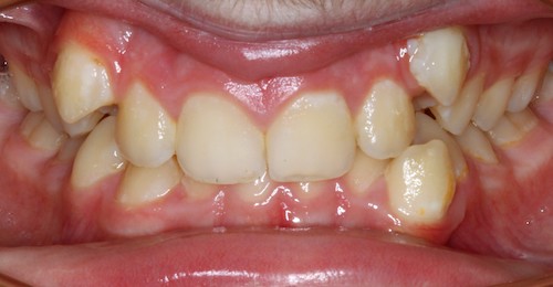 Dentell