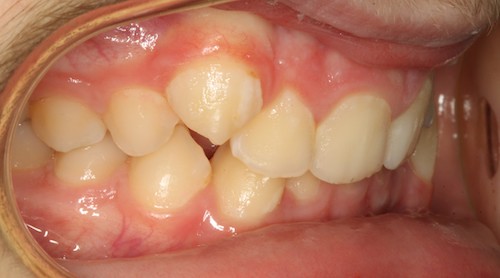 Dentell