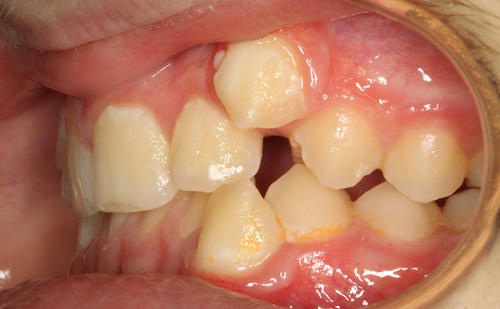 Dentell