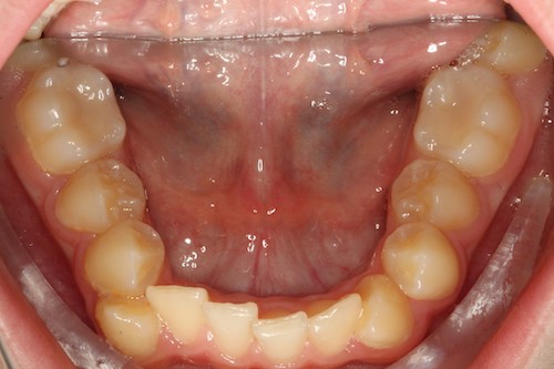 Dentell