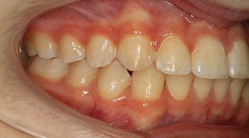 Dentell