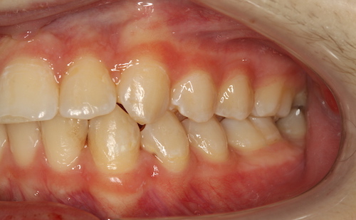 Dentell