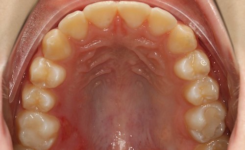 Dentell