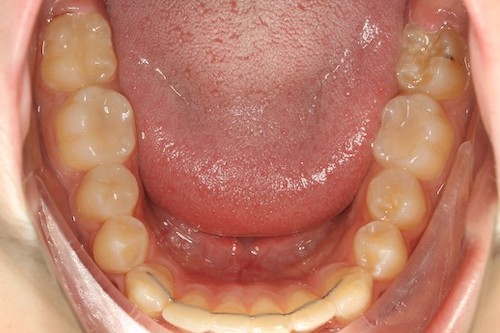 Dentell
