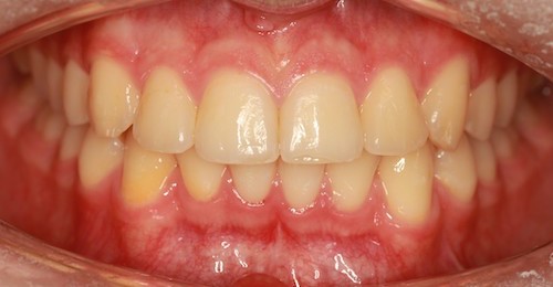 Dentell